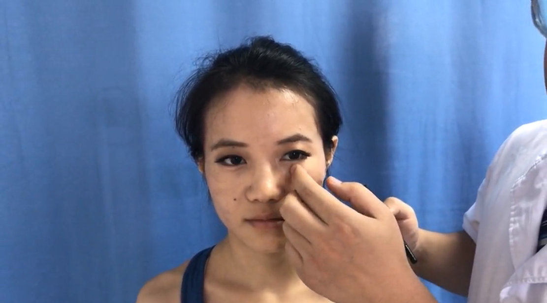 承泣穴 / ST-1 / Chengqi / Receiving Tears