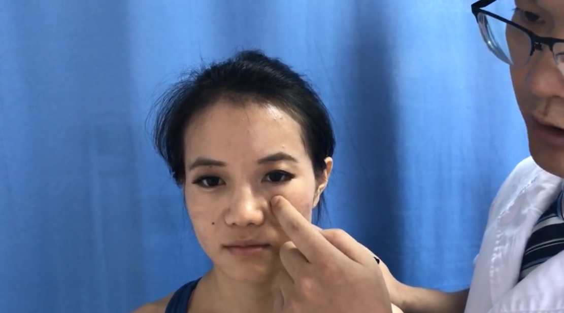 四白穴 /  ST-2 / Sibai / Four Whites