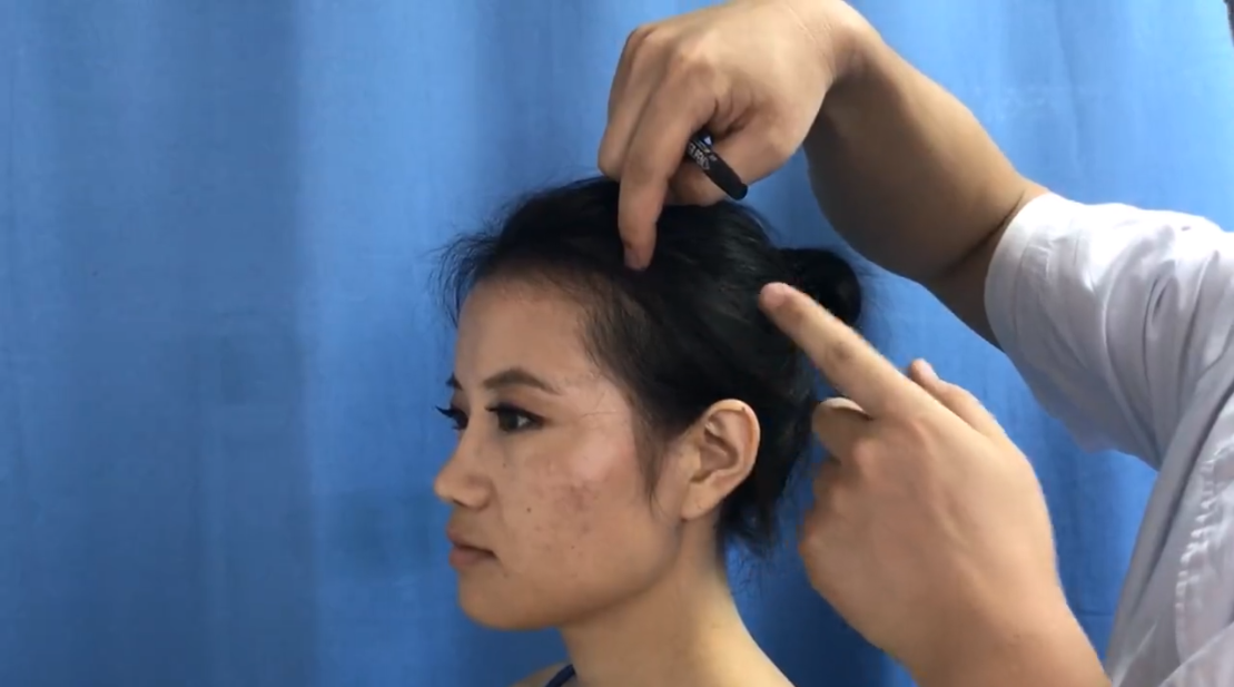头维穴 / ST-8 / Touwei / Head Corner